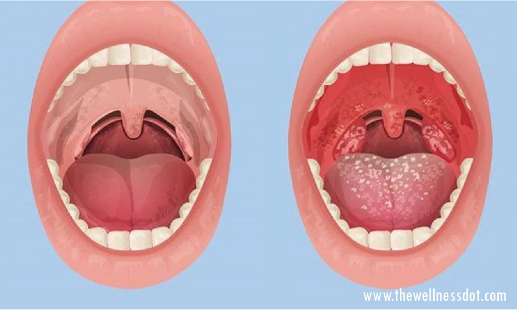 Symptoms of Swollen Tonsils
