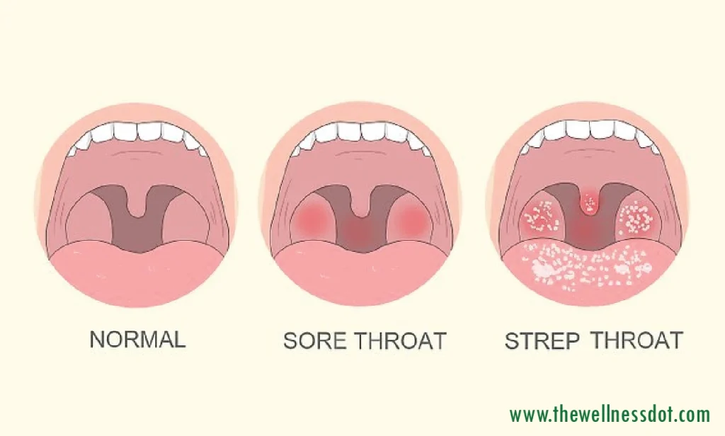 What Causes Strep Throat