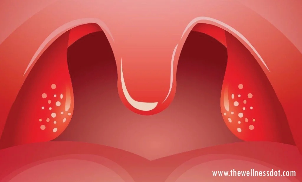 What are Swollen Tonsils?