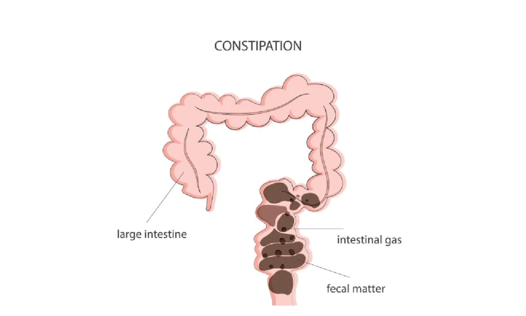 What is Constipation?